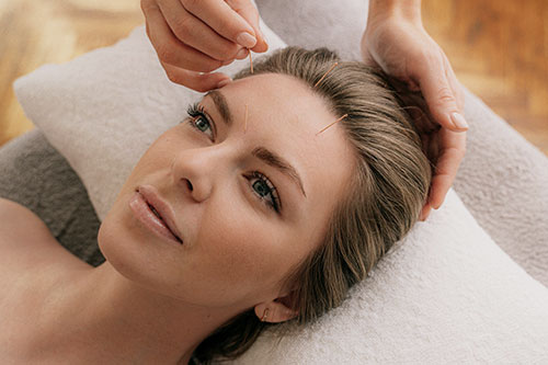 A woman receiving acupuncture near her temple of her forehead.